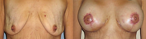 BREAST AUGMENTATION WITH LIFT before after