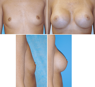 Breast Augmentation Before and After Pictures in Orange County