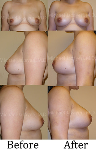 breast augmentation using fat transfer