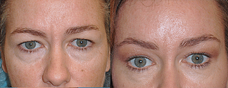 Brow Lift Before and After Photos