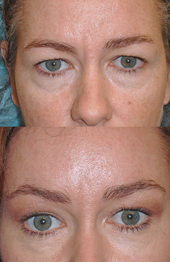 Brow Lift Before & After Photos