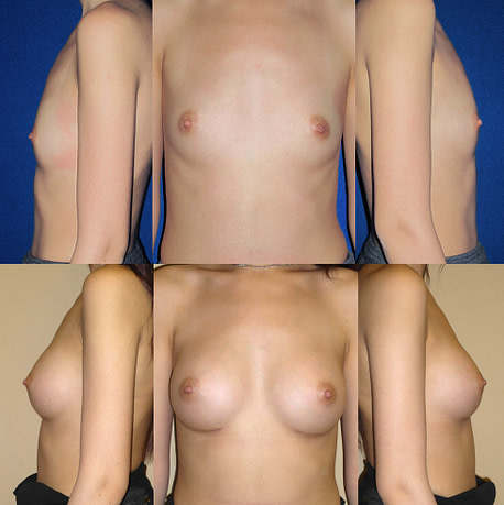breast augmentation in slender patient