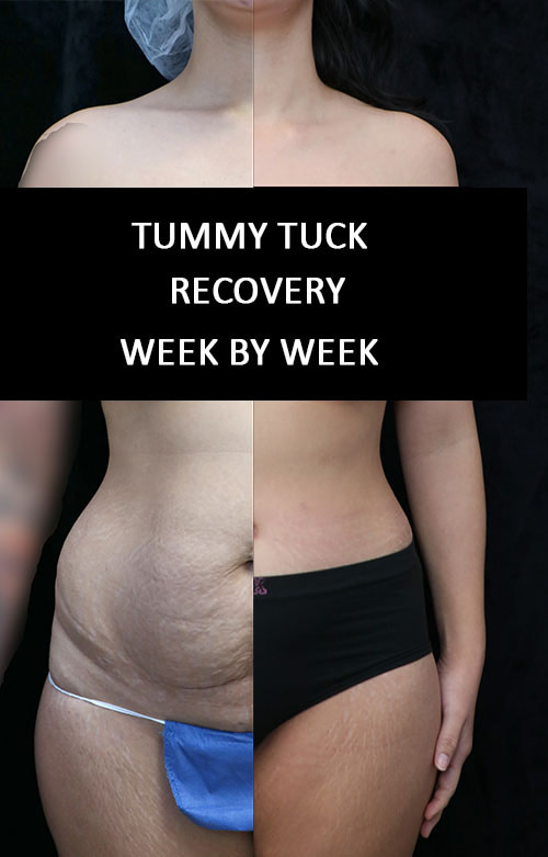 tummy tuck week by week