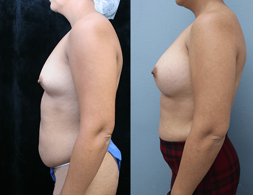 Breast Augmentation with Asymmetry Before & After Photos Left Side