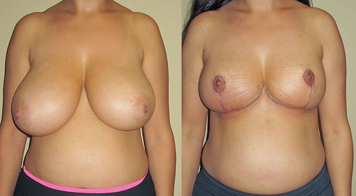 Breast Reduction Before and after photos