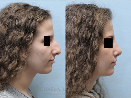 rhinoplasty before and after right