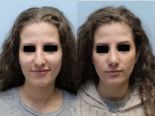 rhinoplasty before and after face