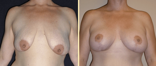 Breast Augmentation With Lift Before and After Photos
