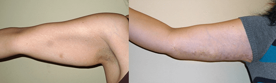 arm lift Before & After Photos