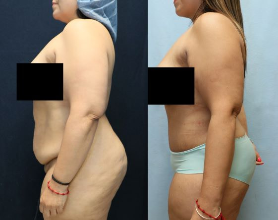 before and after abdominoplasty results left