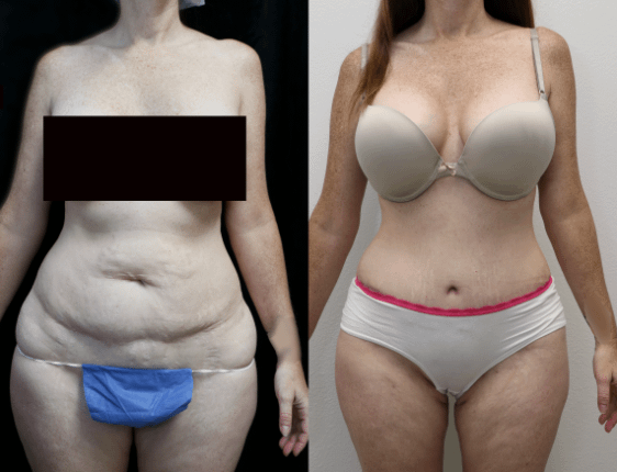 before and after photos of abdominoplasty