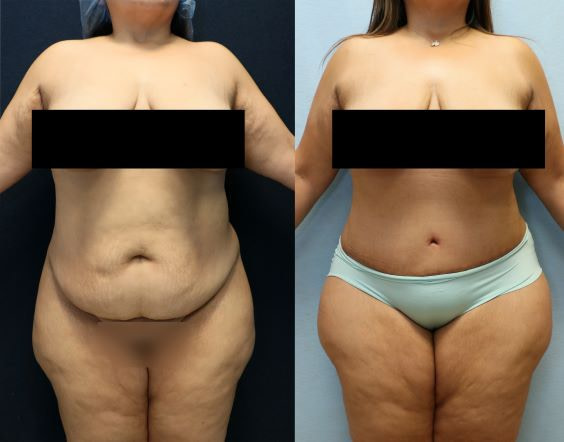 before and after photos abdominoplasty