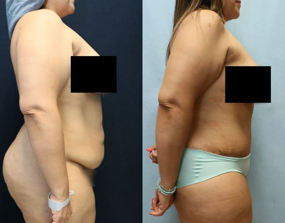 before and after abdominoplasty results right