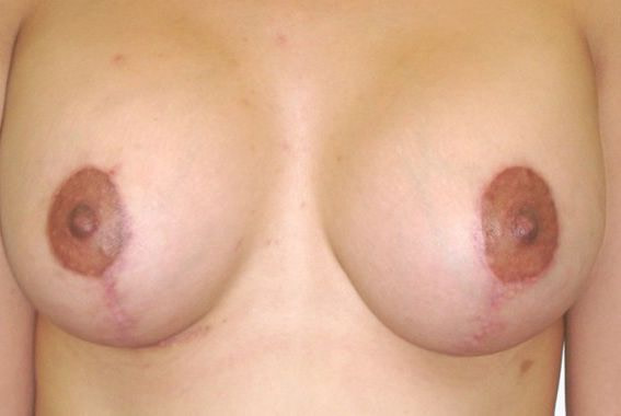 Breast Lift Orange County Before & After Photos
