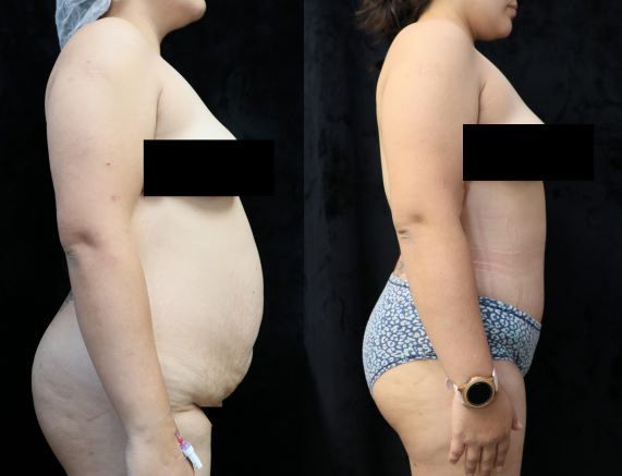 abdominoplasty right before and after
