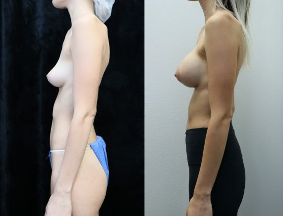 breast augmentation asymmetry before and after