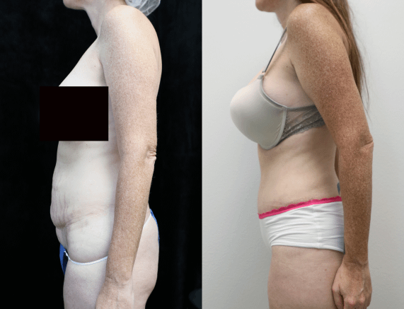 before and after photos of abdominoplasty left