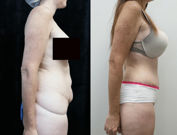 before and after photos of abdominoplasty right