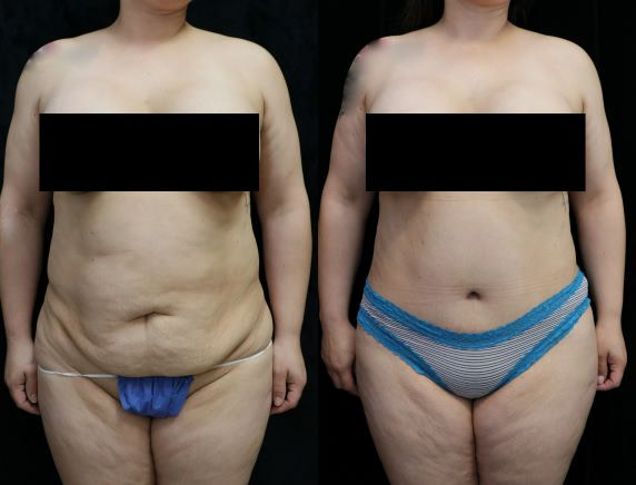 tummy tuck before and after photos front
