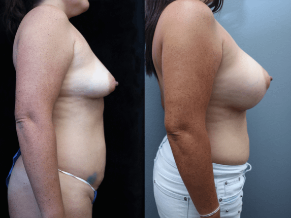 Breast Augmentation with Asymmetry Before & After Photos Right Side