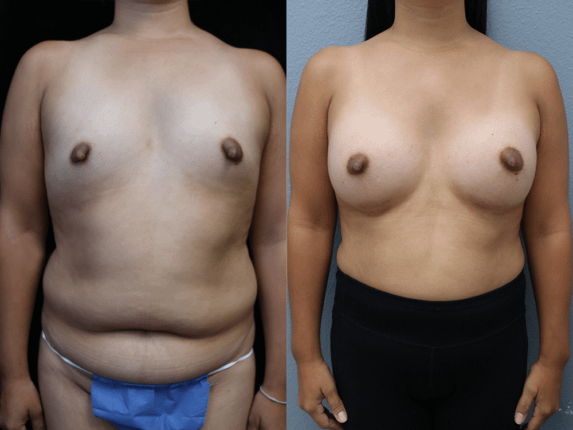 Breast Augmentation with Asymmetry Before & After Photos