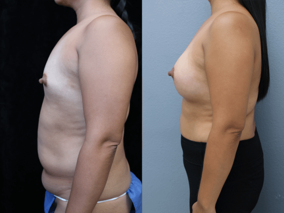 Breast Augmentation with Asymmetry Before & After Photos Left Side