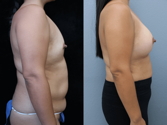 Breast Augmentation with Asymmetry Before & After Photos Right Side