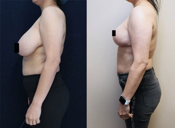 bilateral breast reduction before and after left