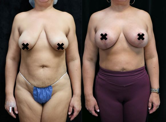 breast lift and augmentation front before and after photo