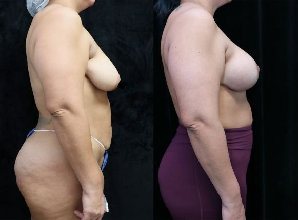 breast lift and augmentation before and after right side photos