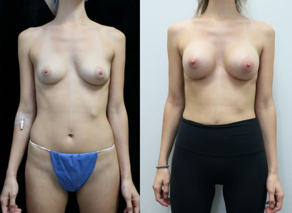 Breast Augmentation with Asymmetry