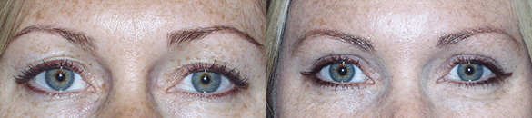 Eyelid Surgery Before & After Photos Front