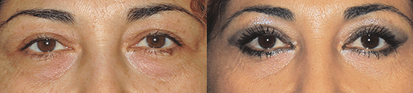 Eyelid Surgery Before & After Photos