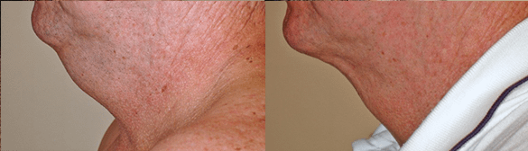 neck liposuction Before & Afte Photos Left