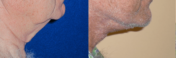Face & Neck Lift for Men Before & After Photos