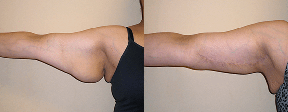 Arm Lift Before & After Photos Left