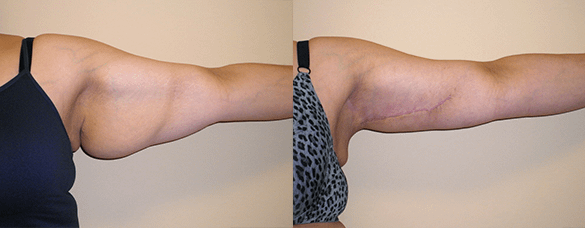 Arm Lift Before & After Photos Right