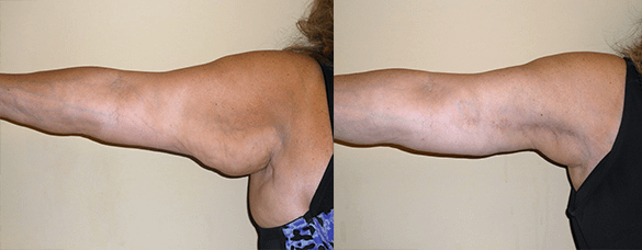 Arm Lift Before & After Photos Left