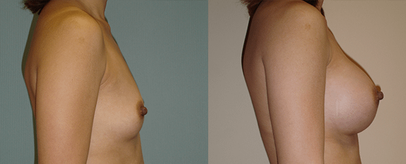 Breast Augmentation Before & After Photos Right
