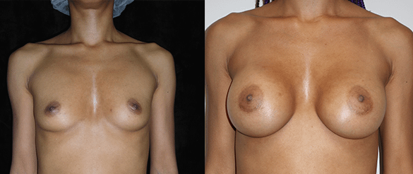 Breast Augmentation Before & After Photos Front