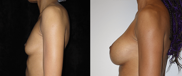 Breast Augmentation Before & After Photos Left