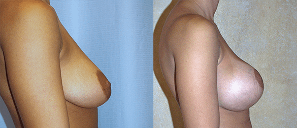 Breast Augmentation With Lift Before & After Photos Right
