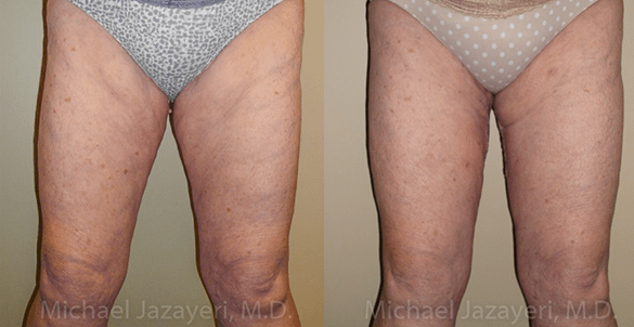 Thigh Lift Before & After Photos