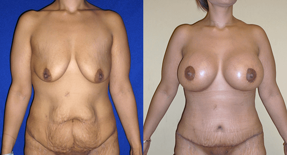 Mommy Makeover & Tummy Tuck Surgery Before & After Photos Front