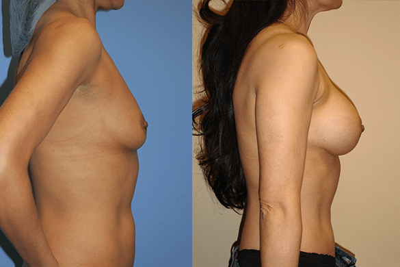 Breast Augmentation Before & After Photos Right