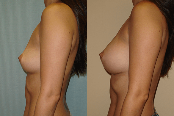 Breast Augmentation Before & After Photos Left