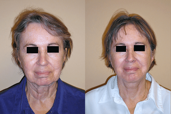 Face and Neck Lift Before & After Photos Front