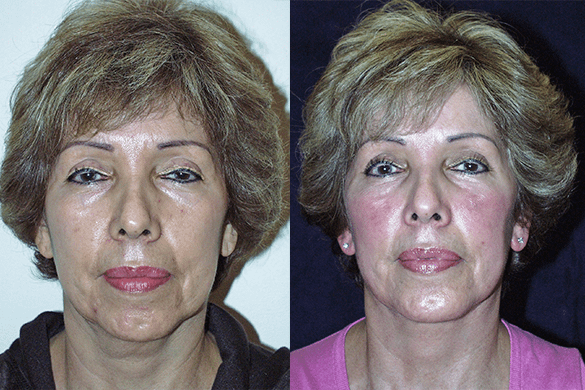 Face and Neck Lift with Chin Augmentation Before & After Photos Front