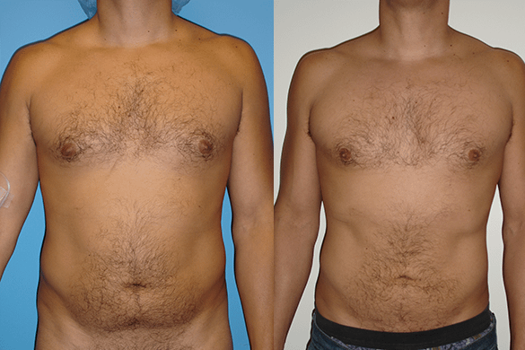 Abdomen Liposuction Before & After Photos Front