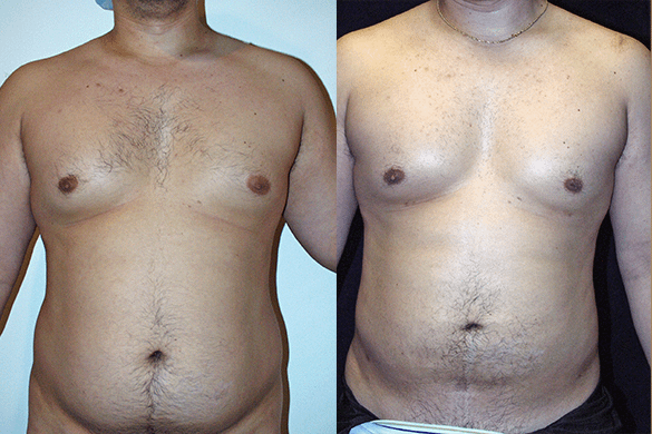 Abdomen, and Chest Liposuction Before & After Photos Front